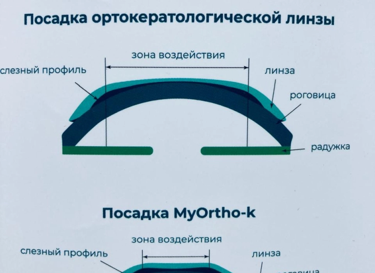Что такое кастомизированная (ортокератологическая) ночная линза?